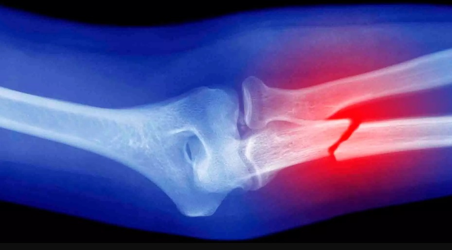 Лечение после перелома кости c БАД'ами NSP